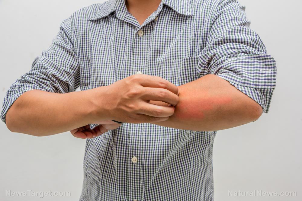 Your Itchy Skin May Indicate A Kidney Condition Research Finds A 